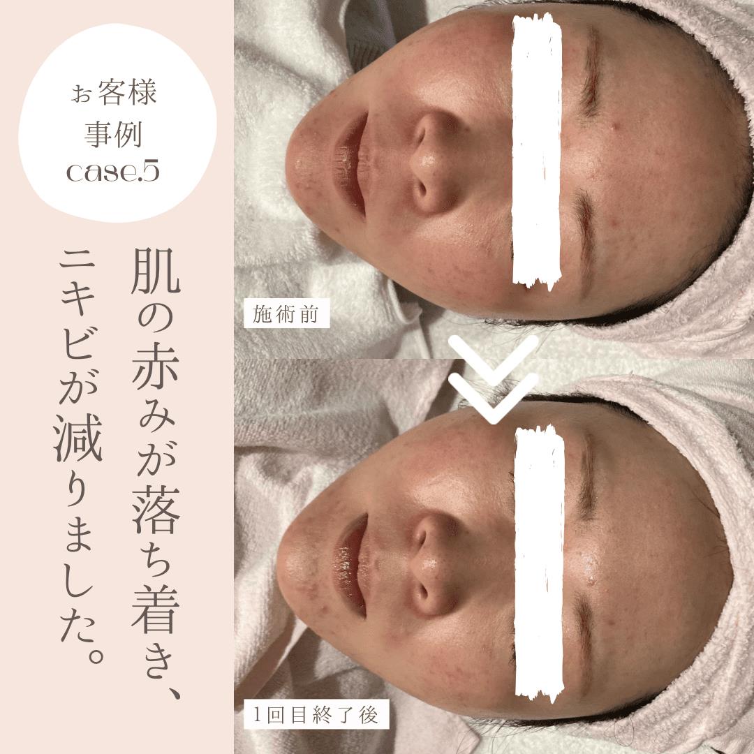 ハーブリプロ/ハーブピーリング お客様事例　Ｎｏ．５🌿